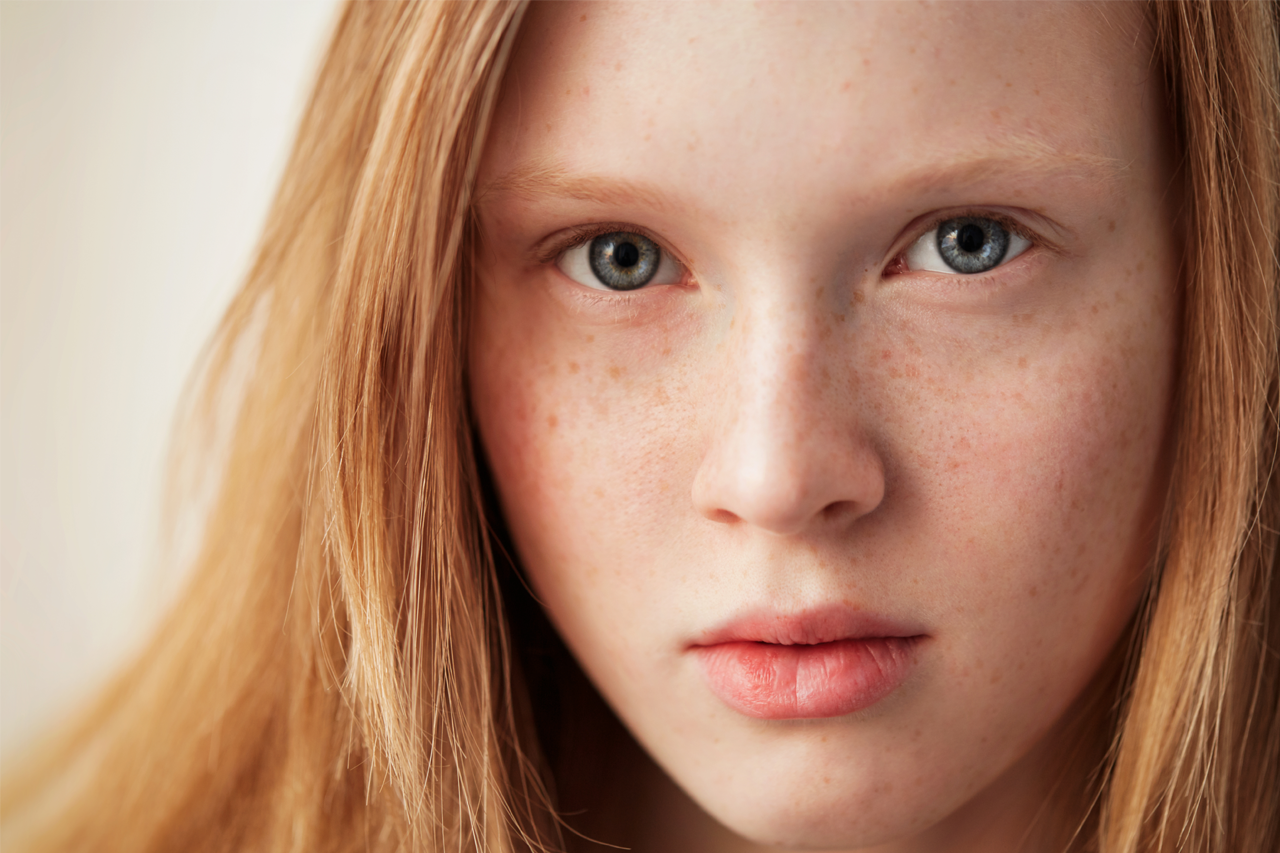 Perbedaan antara Freckles dan Flek Hitam